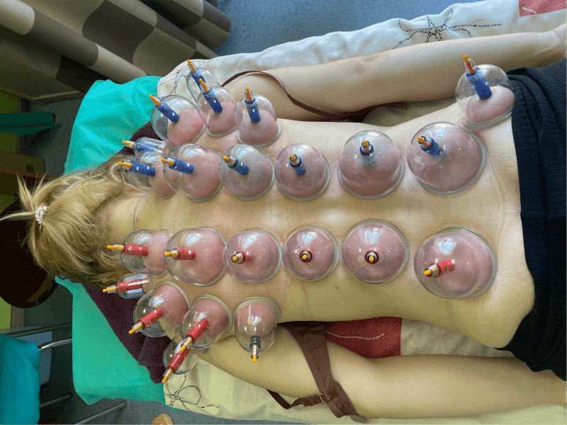 Массаж вакуумными банками