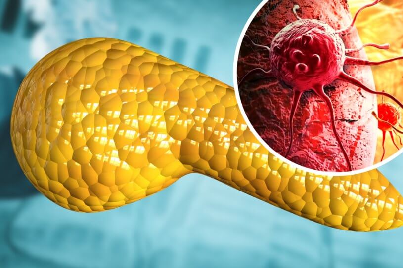 Рак поджелудочной железы